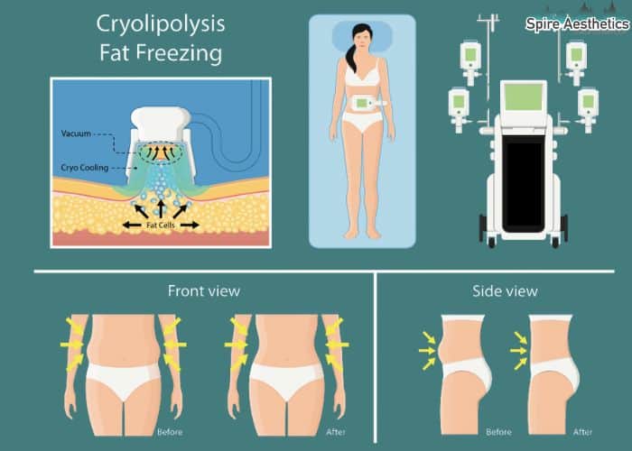 Image of diet and fat freezing combined for best results for Spire Aesthetics The Potteries
