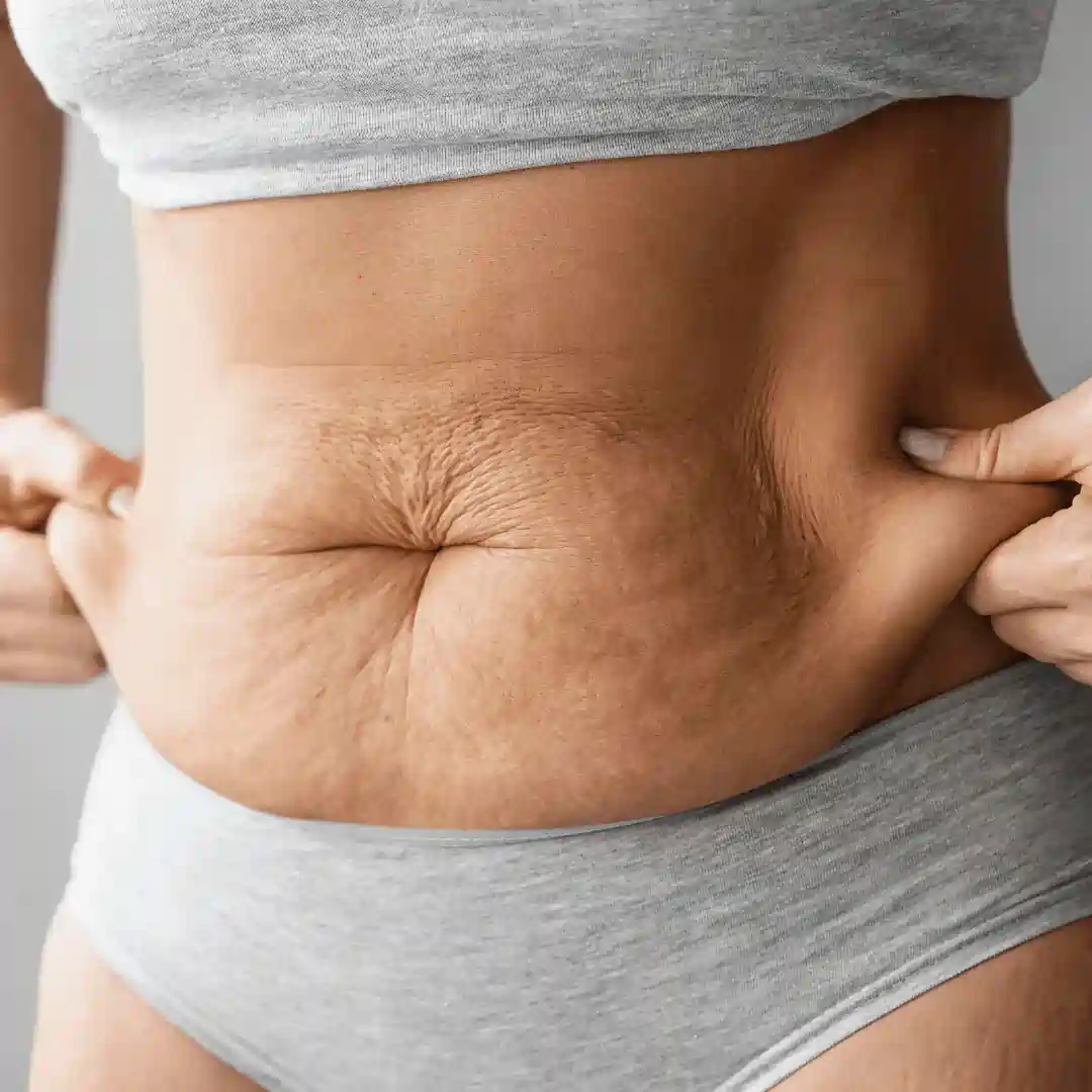 Is It Normal to Have Loose Skin After Pregnancy The Potteries?
